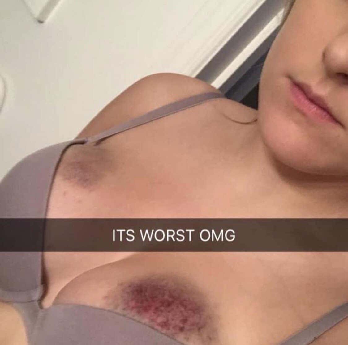 Hickeys on breasts